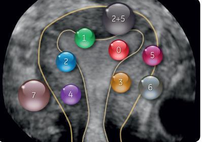 Myom myom a fertilita distorze dutiny redukce implantace fokální zánět sekrece vazoaktivních látek myomectomie a fertilita Bosteels J.