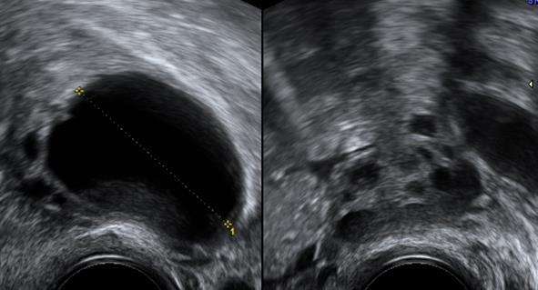 Tumor adnex velikost