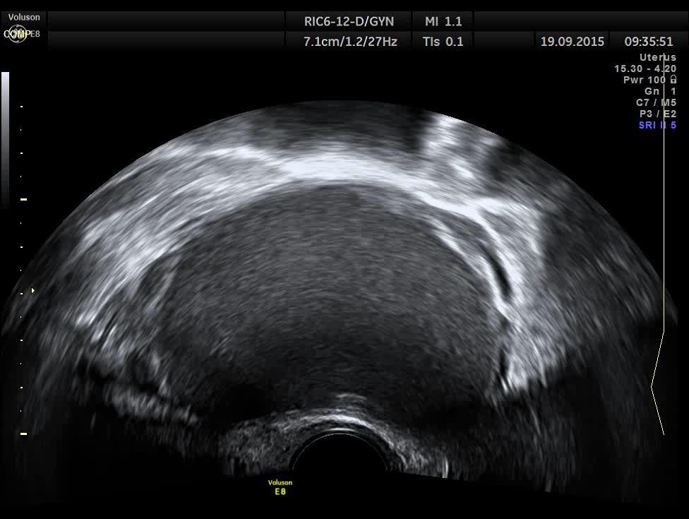 Endometriosa ovaria acoustic