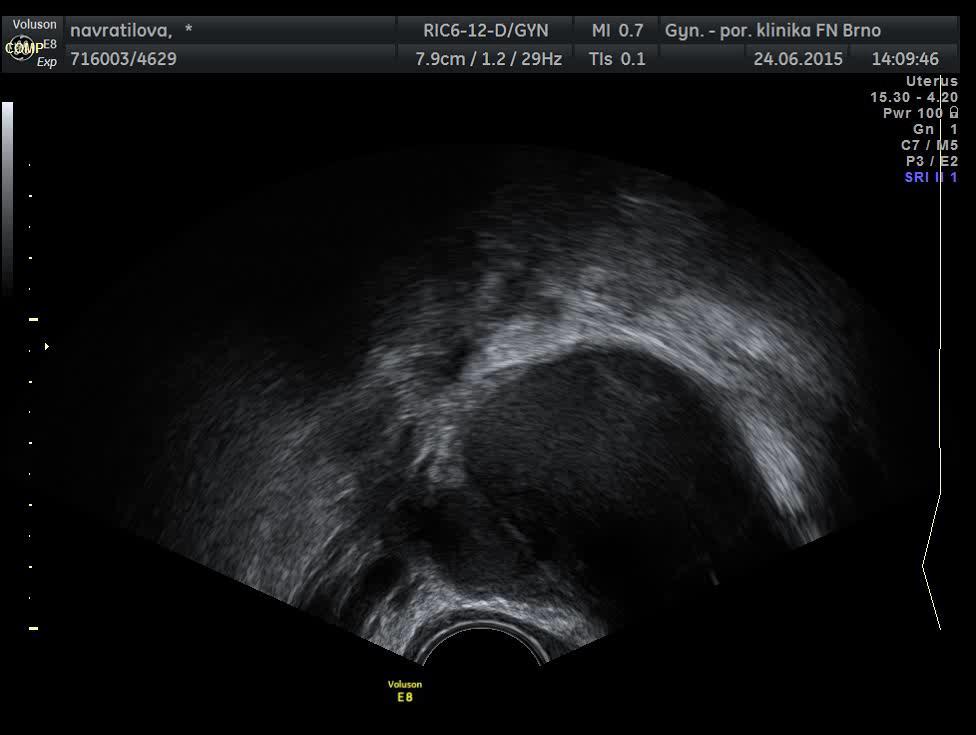 Endometriosa ovaria crescent sign reziduum