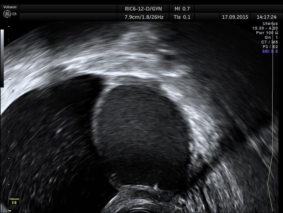 Endometriosa ovaria hyperecho ve stěně hyperechogenní výrůstky/tečky ve stěně endometriomu původ -