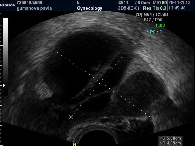 Endometriosa ovaria závěry Typický endometriom