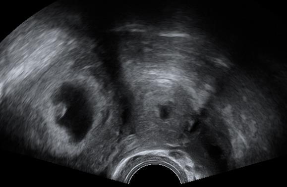 ií Graviditas heterotopica incidence 1/30 000 1% těhotenství po IVF/ET!