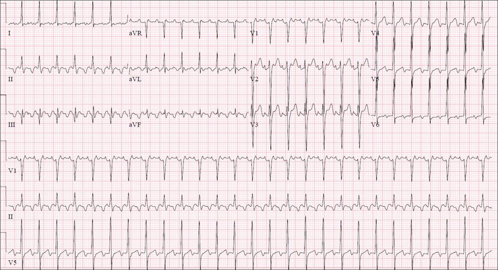 EKG TF