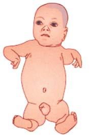 Program prevencie tehotenstva Varovanie: Talidomid spôsobuje vrodené chyby a úmrtie plodu. Nesmiete užívať talidomid, ak ste tehotná alebo by ste mohli otehotnieť.