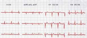 Základní diagnostické metody: Klinické vyšetření RTG vyšetření hrudníku EKG Laboratorní vyšetření ( KO, Plt.