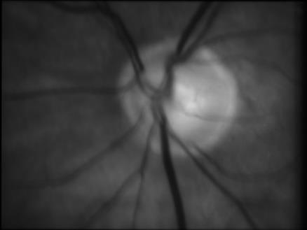 2.7 Vlastnosti získaných dat Pomocí navrženého experimentálního video oftalmoskopu je možné snímat video sekvence od zdravých jedinců i pacientů s případnou oční chorobou.