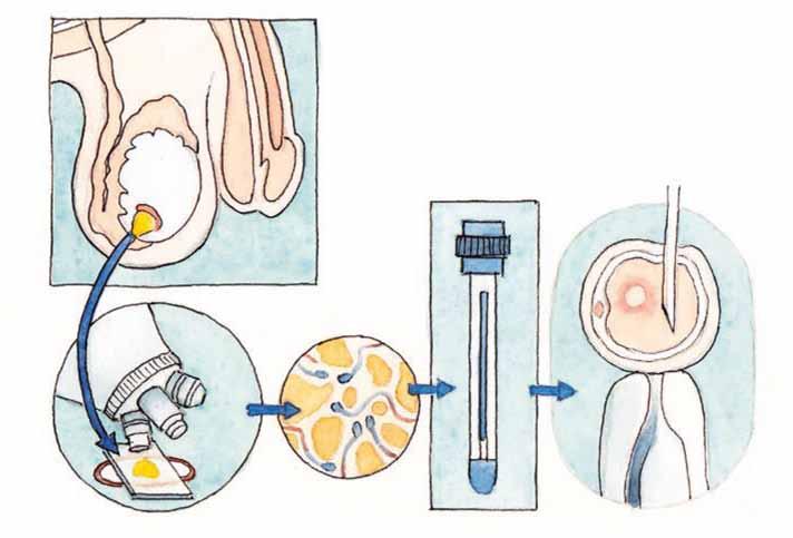 Odběr tkáně z varlete, pokud sperma neobsahuje žádné spermie I když se ve spermatu po chemoterapii nebo radioterapii opakovaně nevyskytují živé spermie, dokážeme často pomocí biopsie
