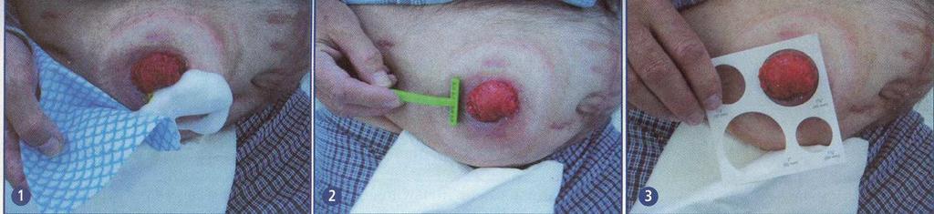 PŘÍLOHA 8 OŠETŘOVÁNÍ STOMIE Ošetřování stomie 1.
