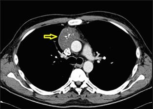 Při sonografii štítné žlázy a krku se setkáváme s: metastázami v