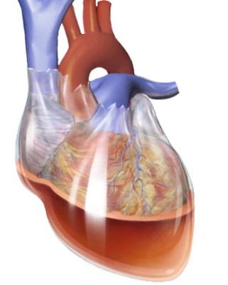 Srdeční tamponáda Patologické nahromadění