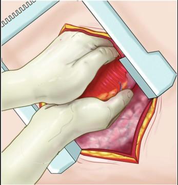 pneumotorax