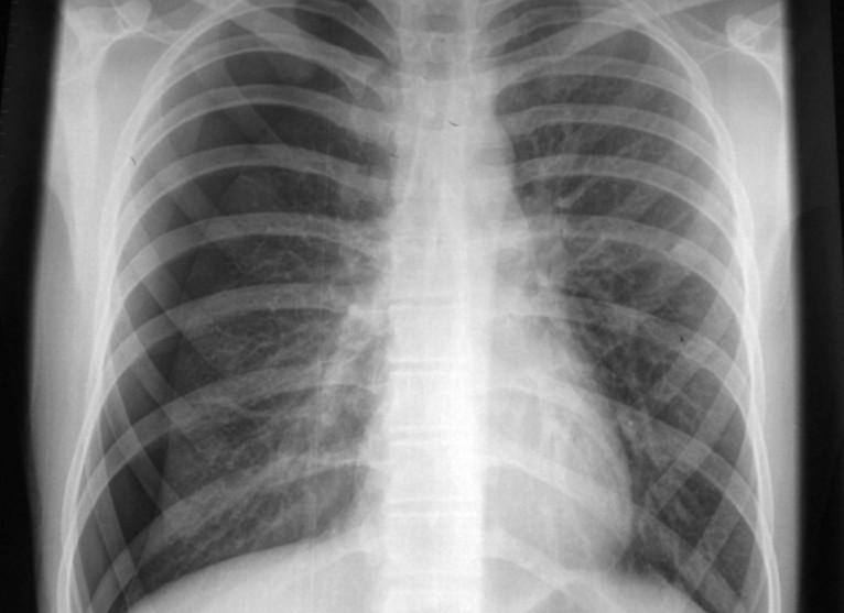 Pneumothorax = patologické nahromadění vzduchu či jiného plynu v pleurální dutině - vzniká při vyrovnání atmosférického a