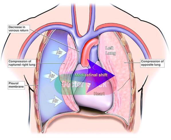 Tenzní pneumothorax Traumatické postižení hrudní stěny záklopkový mechanismus Pacient na UPV s přetlakovým režimem a