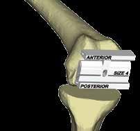 Popis implantátů Operační postup Instrumentárium Katalogová nabídka.