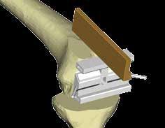 37 kontrola pomocí průhledného pravítka 9 Po dokončení resekce může nastat problém s vytažením kolíků šablony z kosti. Pokud nelze šablonu volně stáhnout rukou, použijte kluzné kladivo 9.