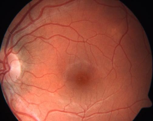 Kapitola 1 Anatomie a fyziologie oční koule 20 Müllerovy buňky Podpůrné buňky, které společně s astrocyty a mikrogliemi patří do skupiny neuroglií.