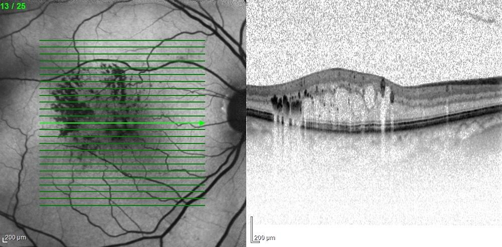 Kapitola 3 Základní a pokročilé vyšetřovací metody v oftalmologii a jejich význam pro 37 diagnostiku Věkem podmíněné makulární degenerace Obrázek 14: OCT vyšetření vlhké formy VPMD Vlevo je zobrazena