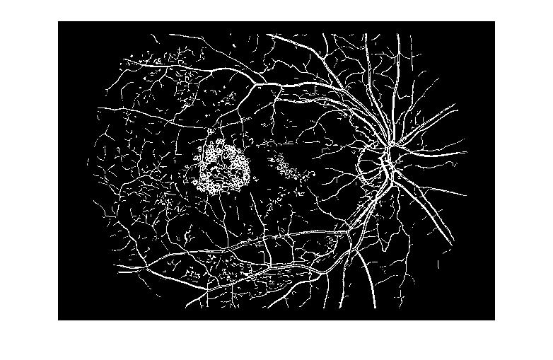 řečiště prahovaný pomocí pevně daného prahu mezi první viditelné projevy diabetické retinopatie, byla detekce nastavena