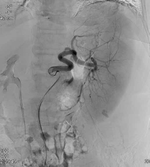 Angiografie potvrdila aktivní extravazaci v místě ruptury sleziny (B).