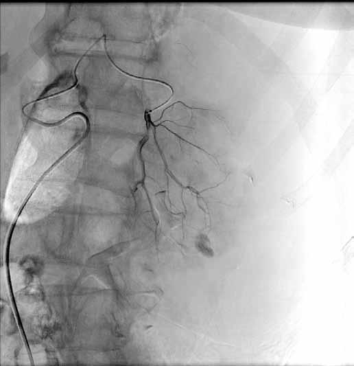 Kontrolní angiografie po embolizaci n-butyl 2-kyanoakrylátem s olejovou kontrastní látkou prokazuje uzávěr krvácejících větví lienální tepny (D).