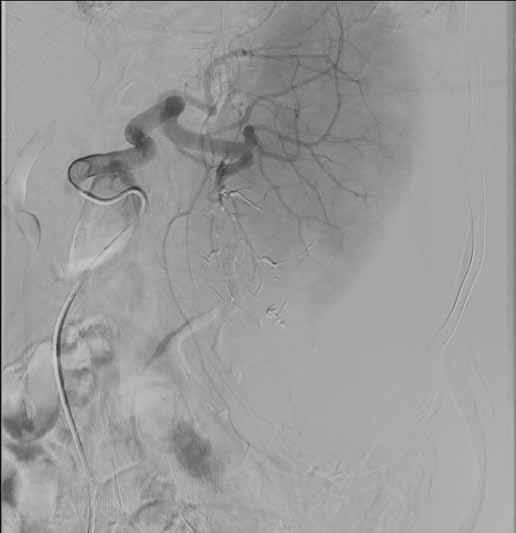 68-year-old woman with myeloproliferative syndrome who presented with spontaneous rupture of the spleen.