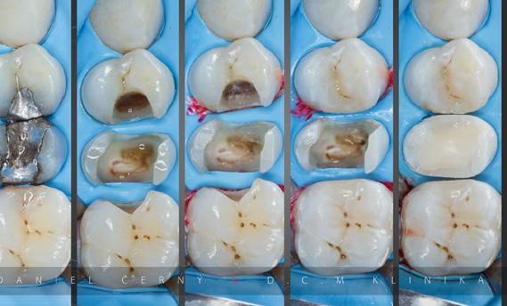 Nástrojové vybavenie odlíšenie potrebného a nepotrebného. 3. Tri najdôležitejšie pomôcky každodennej endodoncie. 4.