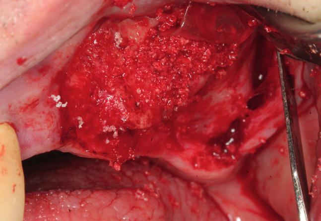 Synthetic Straumann BoneCeramic Syntetický dvoufázový fosforečnan vápenatý Jeden z nejlépe zdokumentovaných syntetických substitučních materiálů na trhu, který vytváří trvalou nosnou konstrukci pro