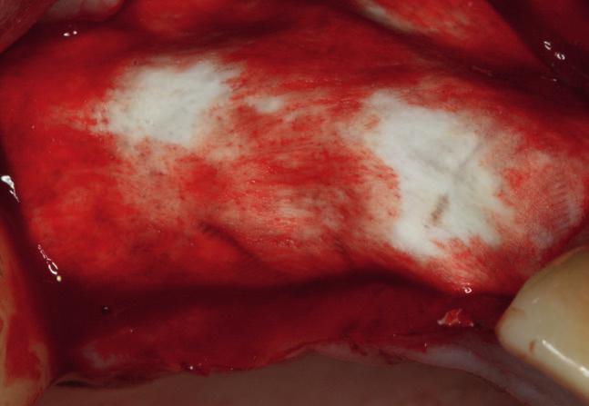 Porcine botiss Jason Pomalu resorbující, přírodní z perikardia Jason je přírodní kolagenní z perikardia porcinního původu, vyvinutá a vyrobená pro regeneraci měkkých a tvrdých tkání.