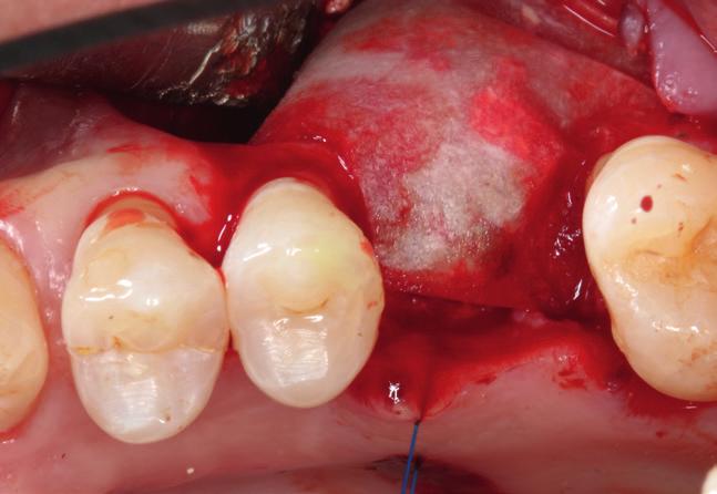 Porcine botiss collprotect Přírodní kolagenní Měkká tkáň se kolem collprotect membrány hojí i při výskytu pooperační dehiscence.