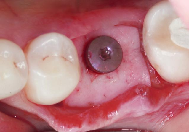 Porcine botiss mucoderm Kolagenní 3D matrix k regeneraci měkkých tkání mucoderm je přírodní typ I/ III kolagenní matrix bez umělého chemického příčného síťování, který se velmi podobá struktuře