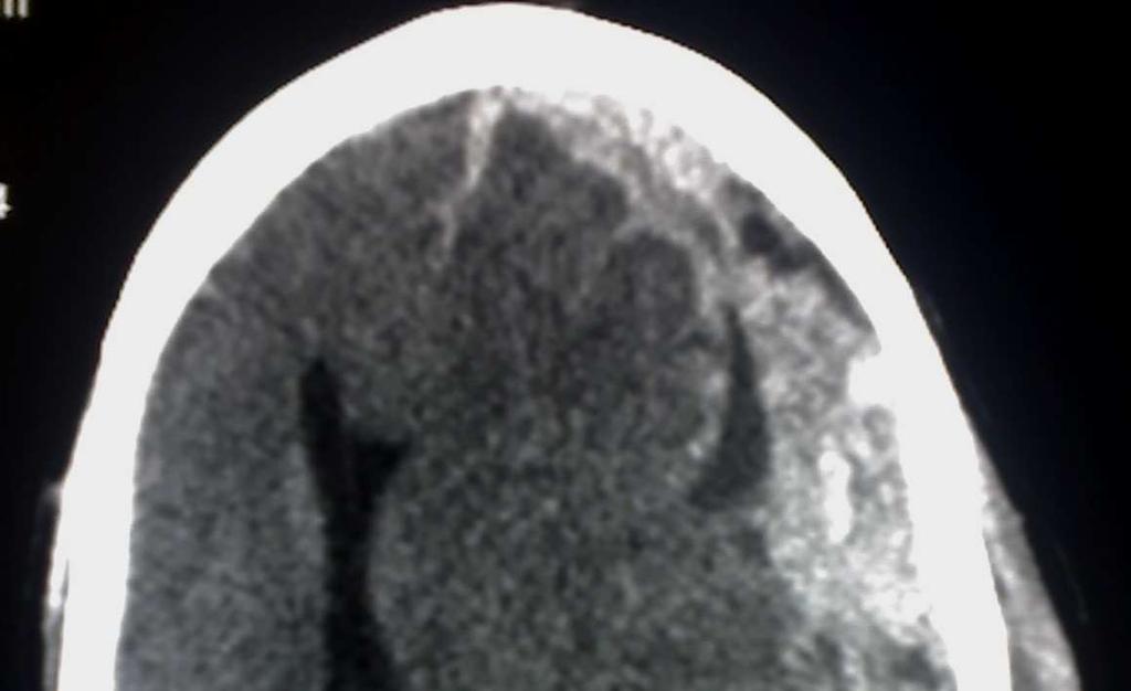 hematomy v CT