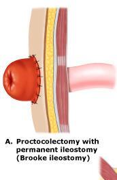 Ulcerózní kolitida Proktektomie s trvalou terminální ileostomií Kompletní odstranění postiženého střeva
