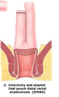 Ulcerózní kolitida Totální kolektomie a staplerová ileo pouch distální rektální anastomóza-ipdra Technicky