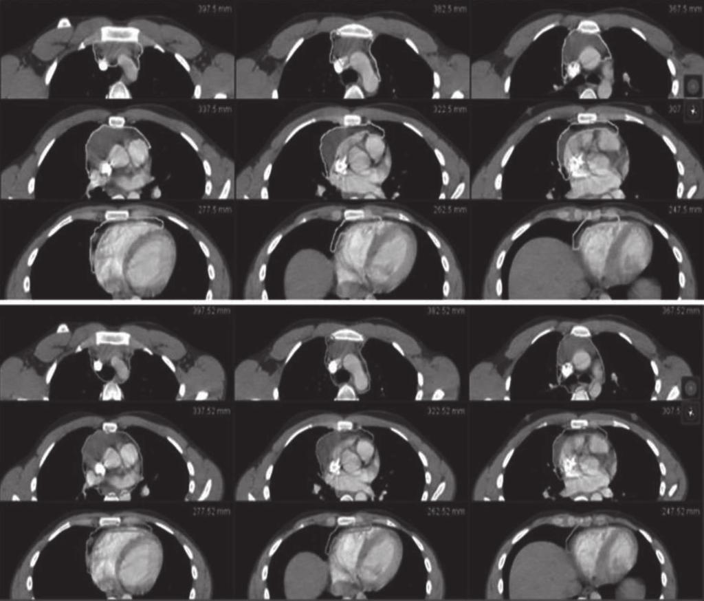 Příklad č. 2: Hodgkinův lymfom st.ib-přední mediastinum se šířením anteriorně před srdce a možným perikardiálním postižením, bez postižení hilárních či subkarinních LU. Stp.