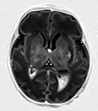 patrné hypoxicko-ischemické léze v bazálních gangliích, thalamech, zadních