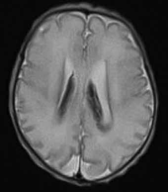 hypoxic-ischemic encephalopathy.
