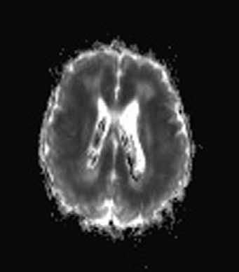 BLADE; E SWI image) show hypoxic-ischemic lesions in the both basal