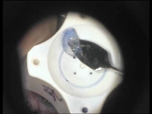 Modifikací této techniky byla implantace lamely ve foldovaném stavu (obr. č. 16), kdy teprve v přední komoře došlo k jejímu spontánnímu rozvinutí a následné fixaci vzduchem.
