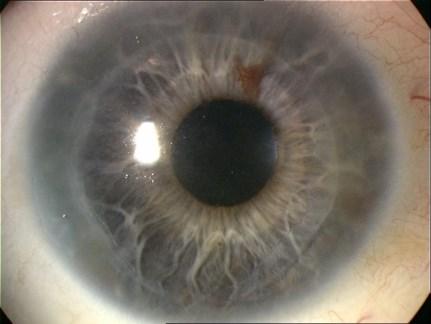 Obrázek 20: Fotodokumentace pacientů po implantaci hybridní lamely DMEK-S. 1.1.3.7. PDEK Tato v literatuře nejnověji zavedená chirurgická metoda transplantace se ve skutečnosti používá již delší dobu.