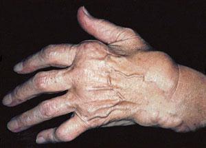 138 OK Pro dekompenzované diabetiky. Na zjišťování okultního (skrytého) krvácení.