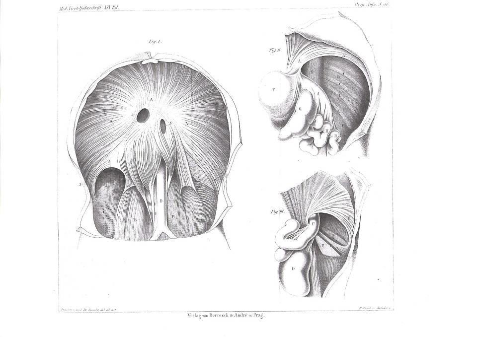 Hernia diaphragmatica