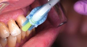 Přístroj AirFloss Ultra je vhodným doplňkem při péči o zanícené