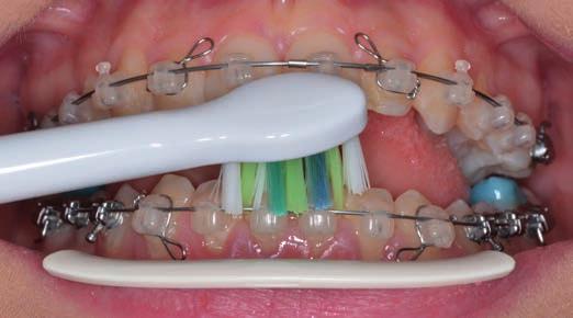 Pacient s protetickou prací Philips Oral