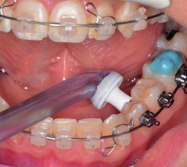 Zvýšená potřeba hygieny a odlišná technika