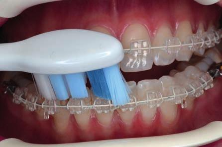 mezizubních prostor Trysky AirFloss Ultra