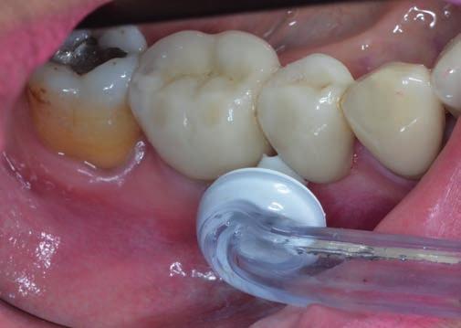 Gum Care Zachycení detailu prostřiku aerosolu při čištění s