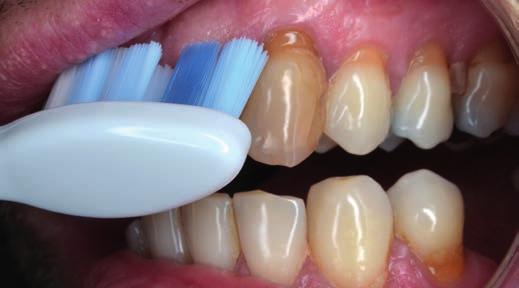 Pigmentace Hlavice Optimal White je