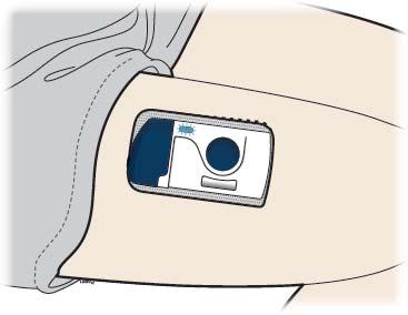 Blikající světlo NEBO píp-píp-píp Naplněný automatický minidávkovač bude umístěn rovně na Vašem těle.