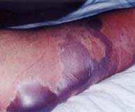 osteomyelitidy, konjunktivitidy Ecthyma Gangrenosum Celulitis Rezistence k ampicilinu, penicilinu